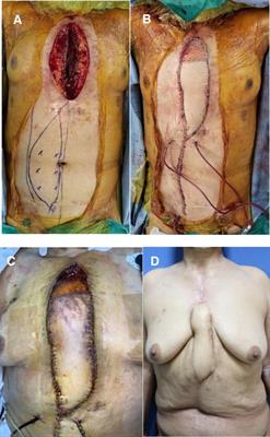 Successful pedicled vertical rectus abdominis myocutaneous flap reconstruction with negative-pressure wound therapy for deep sternal wound infection: a case report and comprehensive review